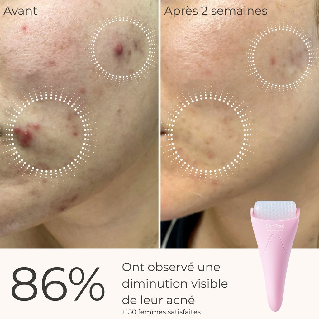 Cryo Roller Zéro Imperfections